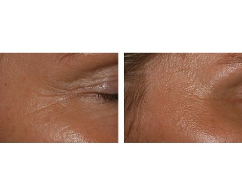 Botox zur Behandlung der Krähenfüße