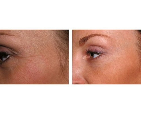Botox zur Behandlung der Krähenfüße