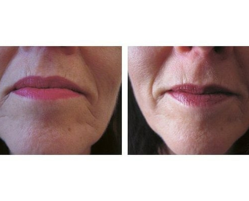 Botox zur Behandlung hängender Mundwinkel