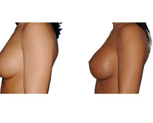 Vorher und Nacher Bild einer Brustvergrösserung mit Silikonimplantaten.