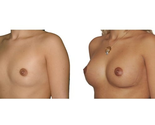 Vorher Nachher Bild einer Brustvergrösserung mit Implantaten.