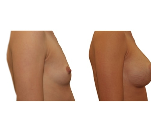 Vorher Nachher Bild einer Brustvergrösserung mit Implantaten.