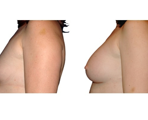 Vorher und Nacher Bild einer Brustvergrösserung mit Silikonimplantaten.