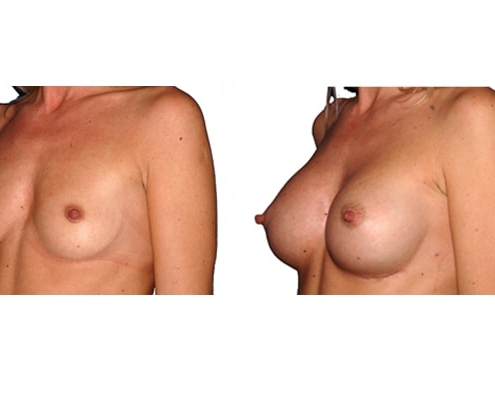 Bild vor und nach einer Brustvergrösserung mit Silikonimplantaten.