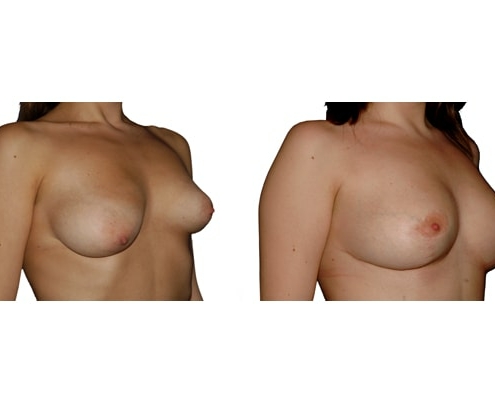 Brustvergrösserung und Symetrieherstellung mit Implantaten und einseitiger Bruststraffung.