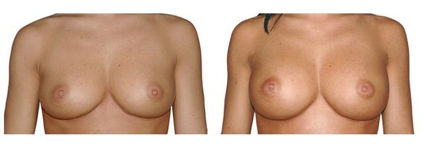Brustvergrößerung mit Silikonimplantaten über dem Muskel.