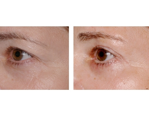 Beispiel einer Augenlidstraffung, Brauenlifting und Eigenfetttransplantation