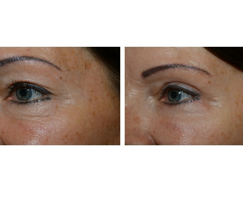 vorher nachher Beispiel einer Augenlidstraffung mit Brauenlifting und Eigenfetttransplantation