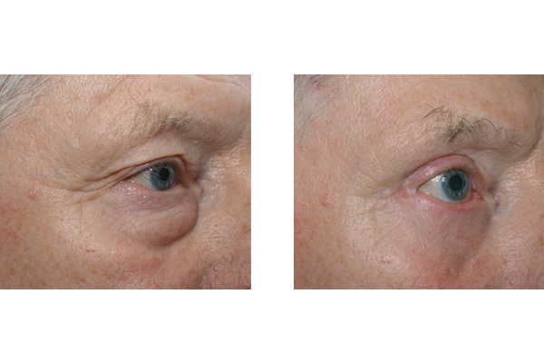 Vorher Nachher einer Korrektur von Tränensäcken und Schlupflidern mit anschließender Augenbrauenhebung