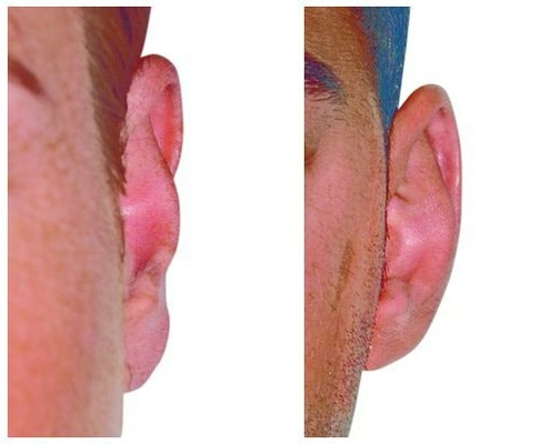 Abstehendes Ohr aufgrund zu breiter Concha