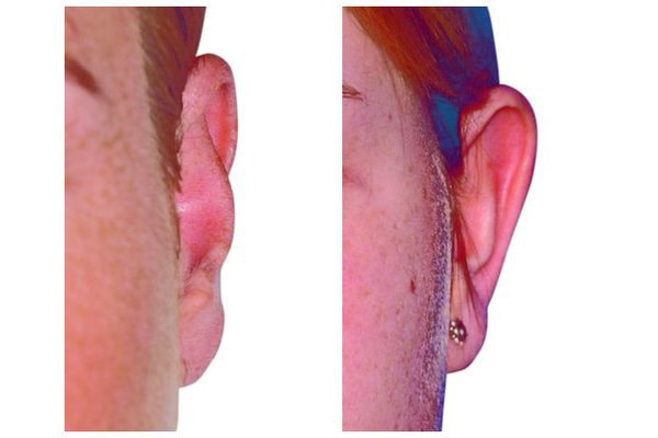 Abstehendes Ohr aufgrund eines stumpfen Anthelixwinkels