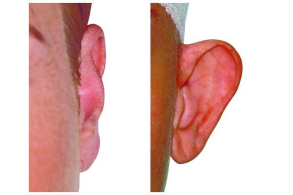 Korrektur eines abstehendes Ohr aufgrund eines stumpfen Anthelixwinkels und zu breiter Concha