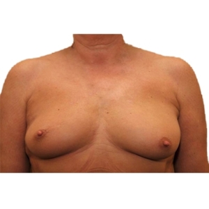 Das Ergebnis der Eigenfetttransplantation ein Jahr nach der Operation.
