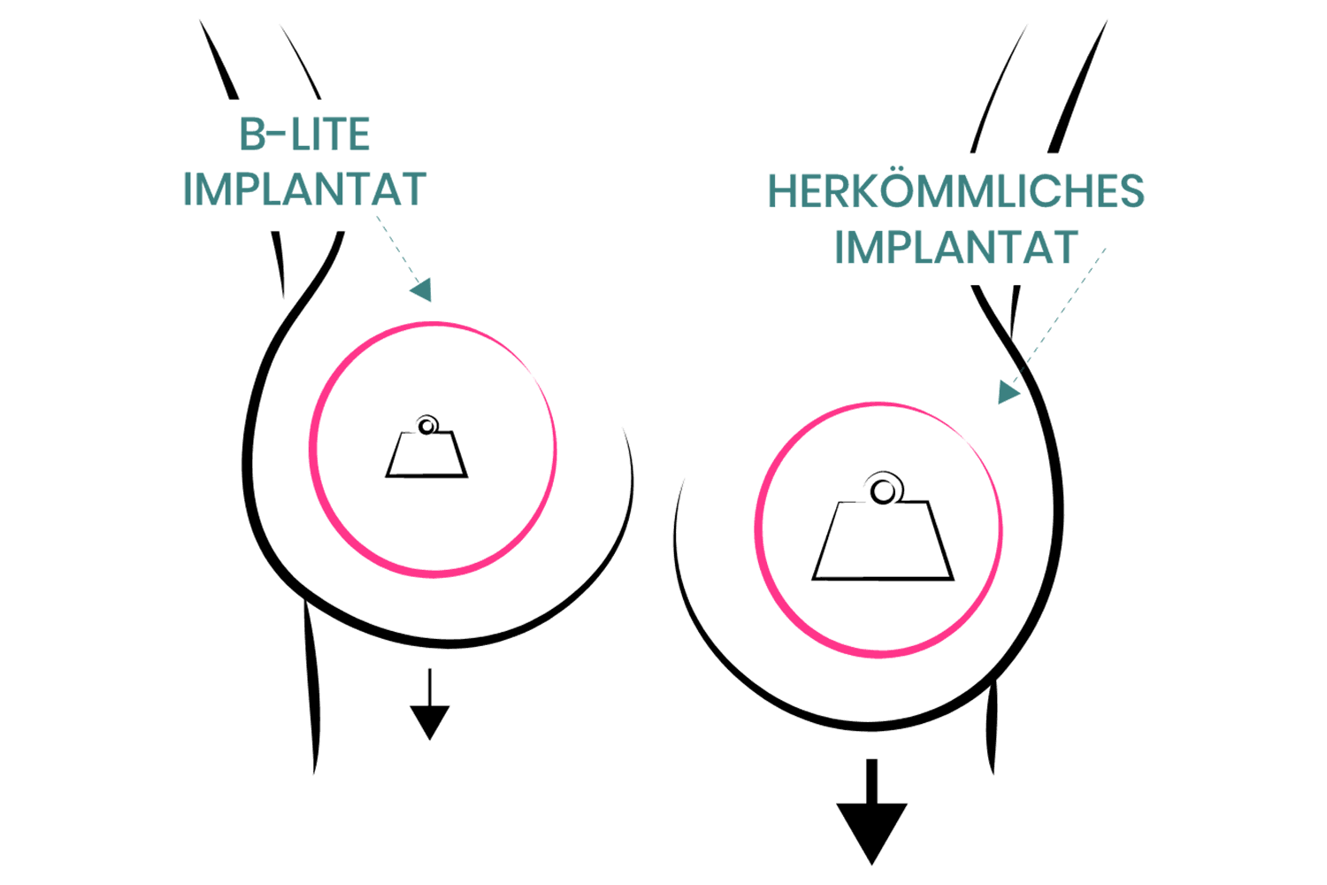 Gewichtsunterschied herkömmlicher Silikonimplantate und B-lite Leichtimplantate