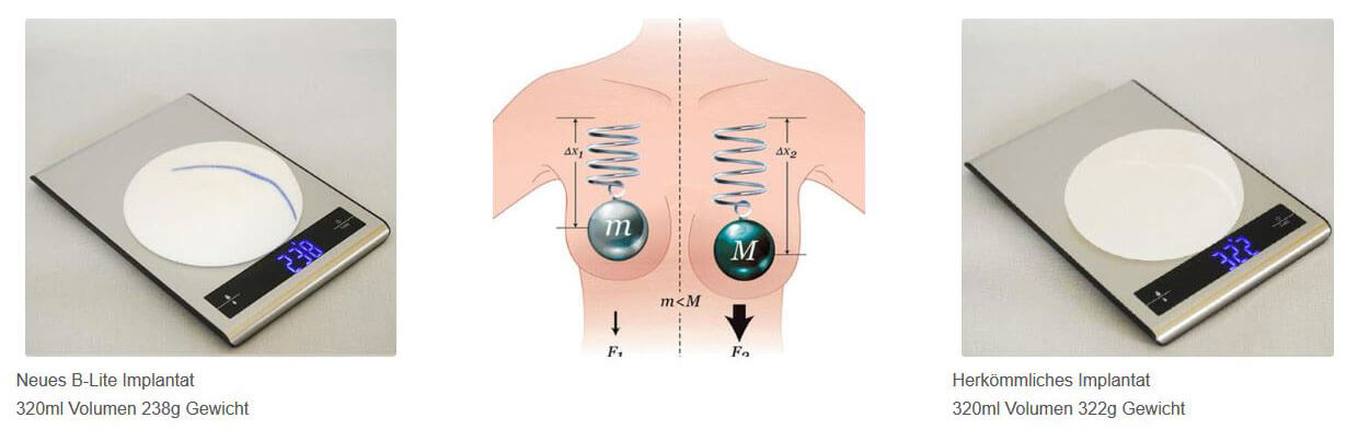 Vergleich des Gewichtes von herkömmlichen Brustimplantaten zu Leichtimplantaten.