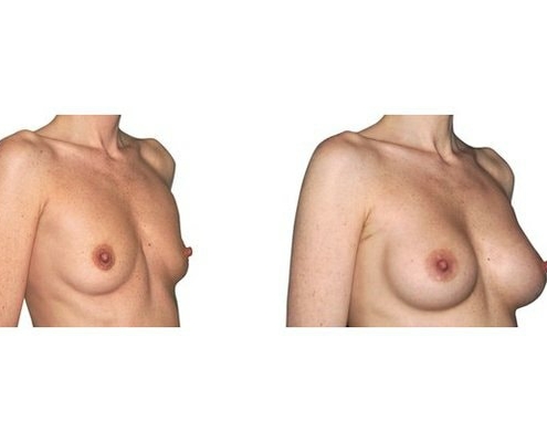 Brustvergroesserung Mit Positionierung Der Implantate Unter Dem Muskel und Zugang Ueber Die Achsel