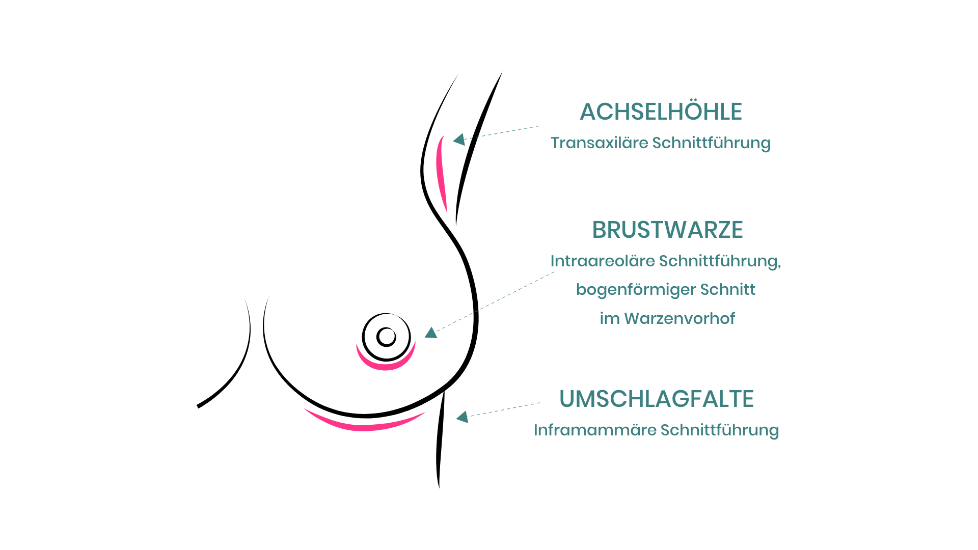 Schnitttechniken bei der Brustvergrößerung mit Implantaten.