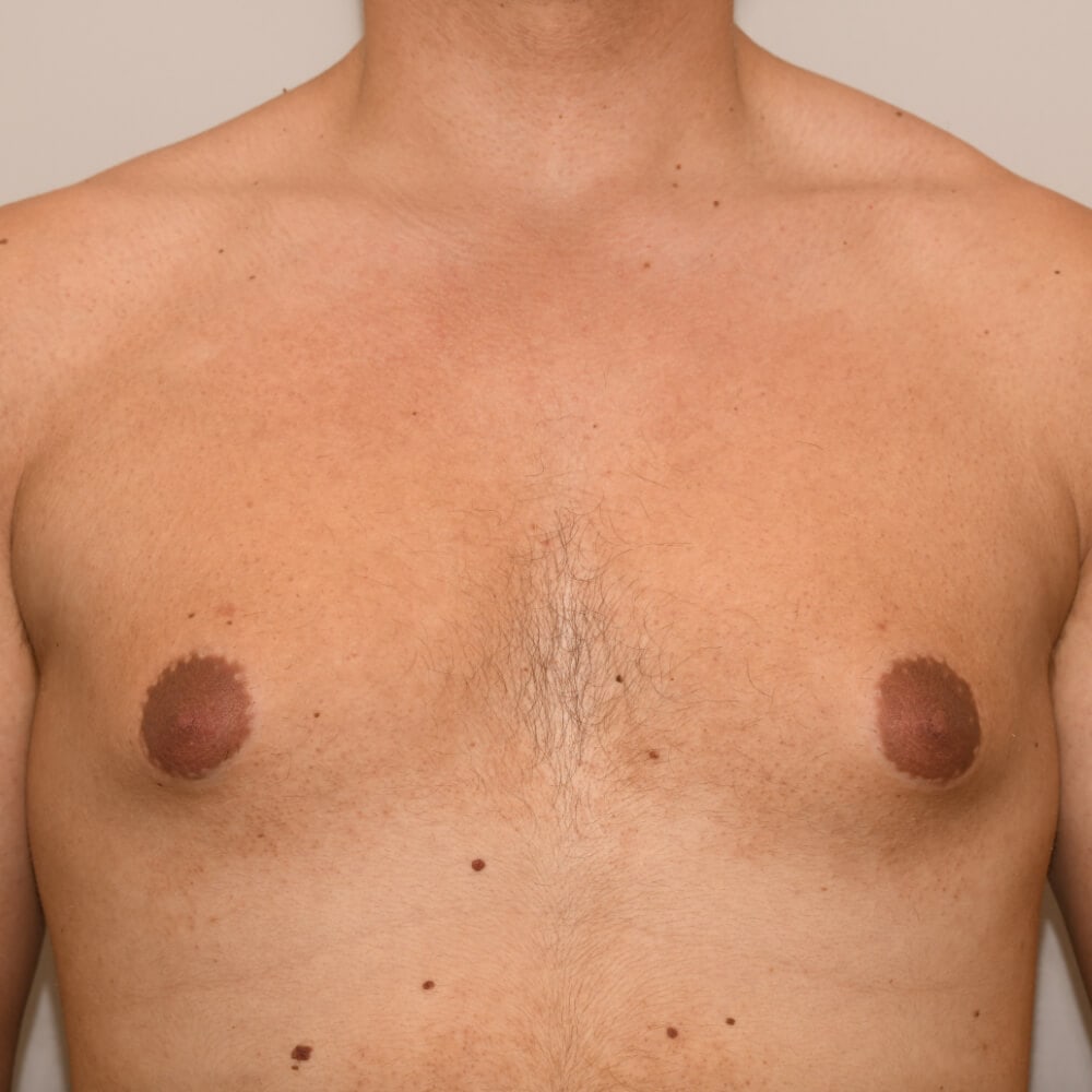 Bei diesem Patienten kann man sehr deutlich eine Mischform, sprich vermehrt Brustdrüsengewebe und eine Fettansammlung erkennen.