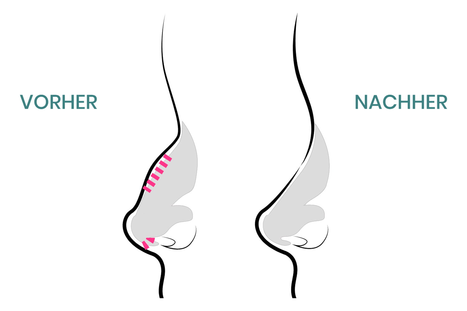 Bei der Nasen Op können Höckern auf dem Nasenrücken entfernt werden.