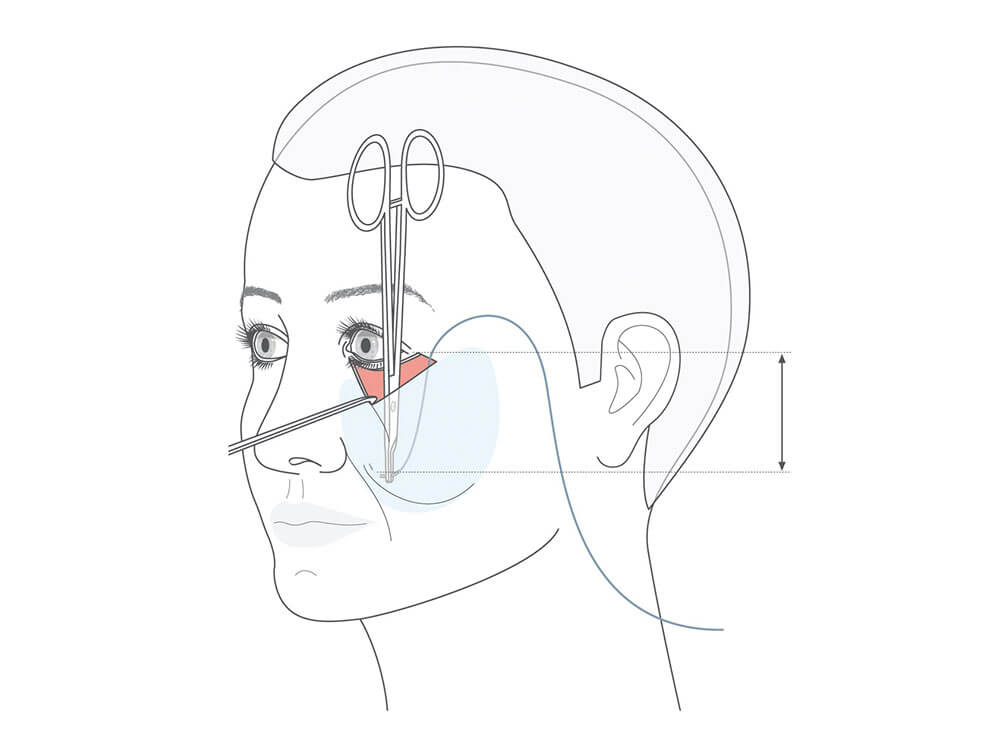 Mittelgesicht Facelifting superiostal