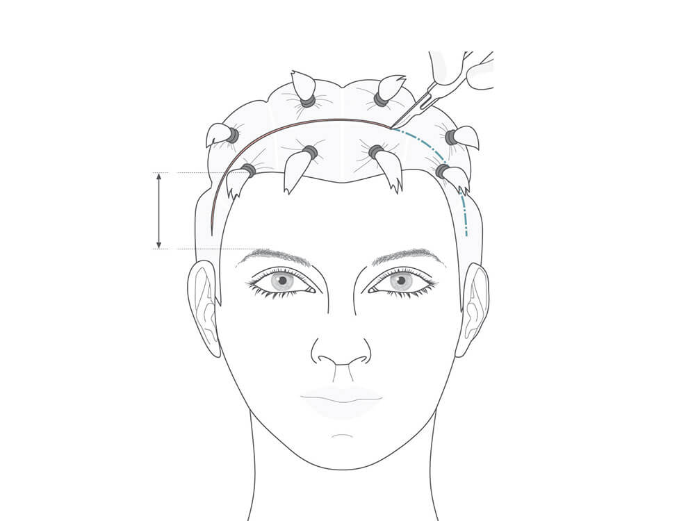 Bei einem coronaren Stirnlifting verläuft der Hautschnitt bogenförmig innerhalb der behaarten Kopfhaut.