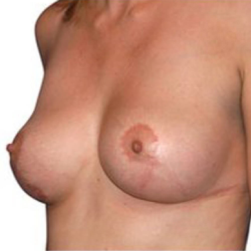 Brustvergroesserung mit Silikonimplantaten nachher