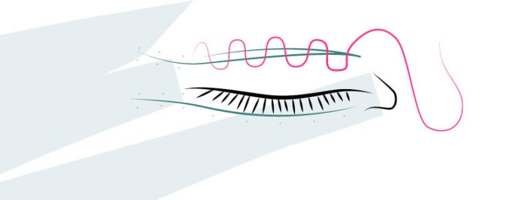 Illustration einer Augenlidkorrektur mit chirurgischem Instrument.
