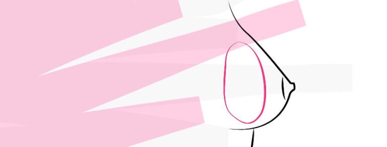 Brustvergrößerung mit Implantaten, plastische Chirurgie.