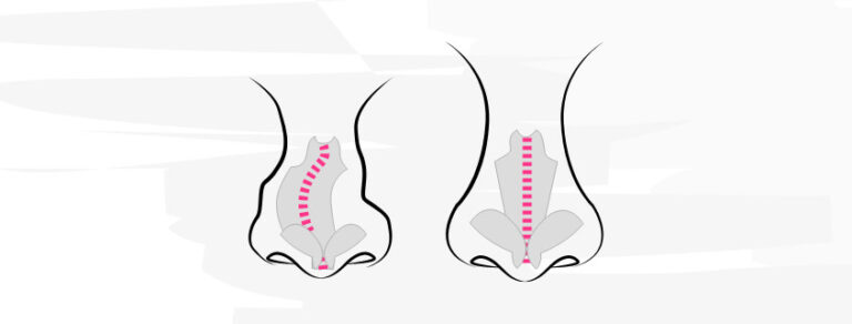 Illustration einer Nasenkorrektur mit chirurgischem Eingriff an der Nase.