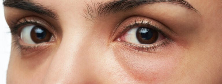 Frau mit geschwollenen Tränensäcken um die Augen, Anzeichen von Müdigkeit.