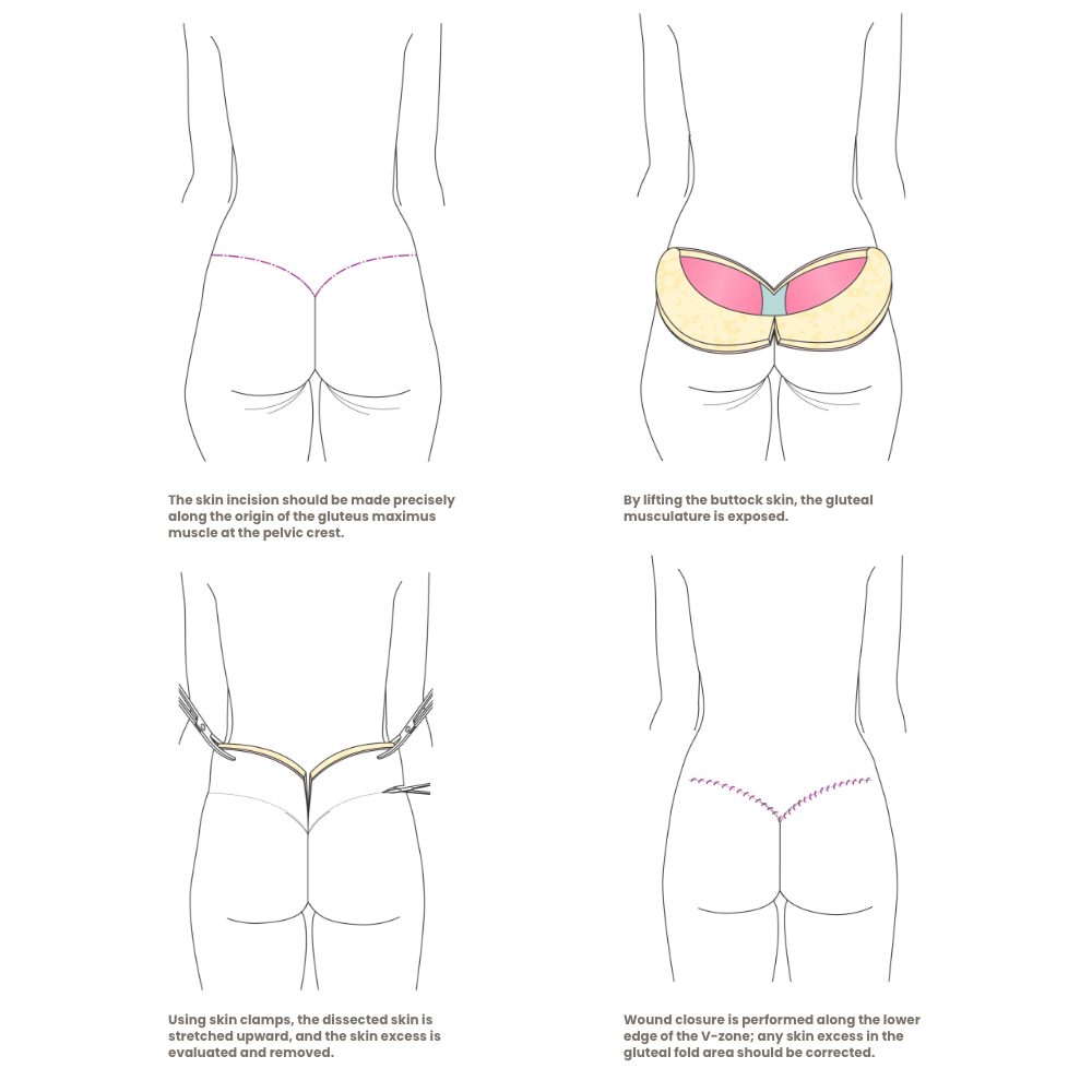 gesaessstraffung-schema