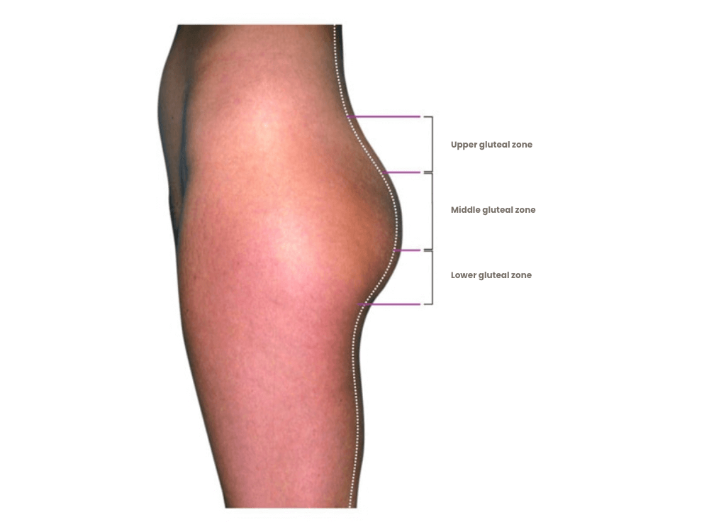 gesaessstraffung-zonen-detail