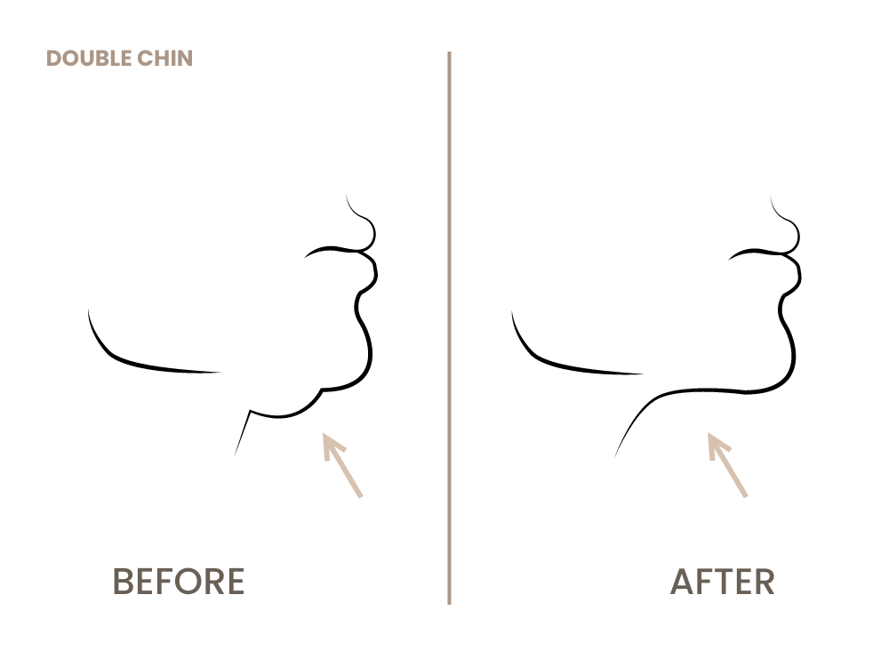 kinnkorrektur-doppelkinn