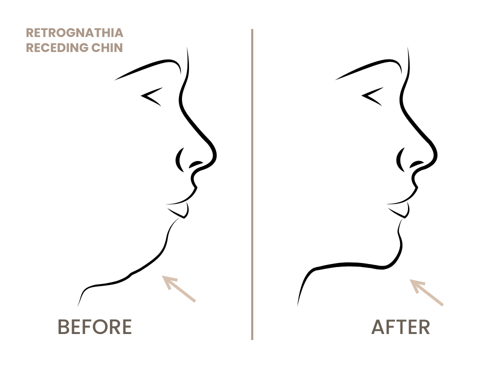 kinnkorrektur-fliehendes-kinn