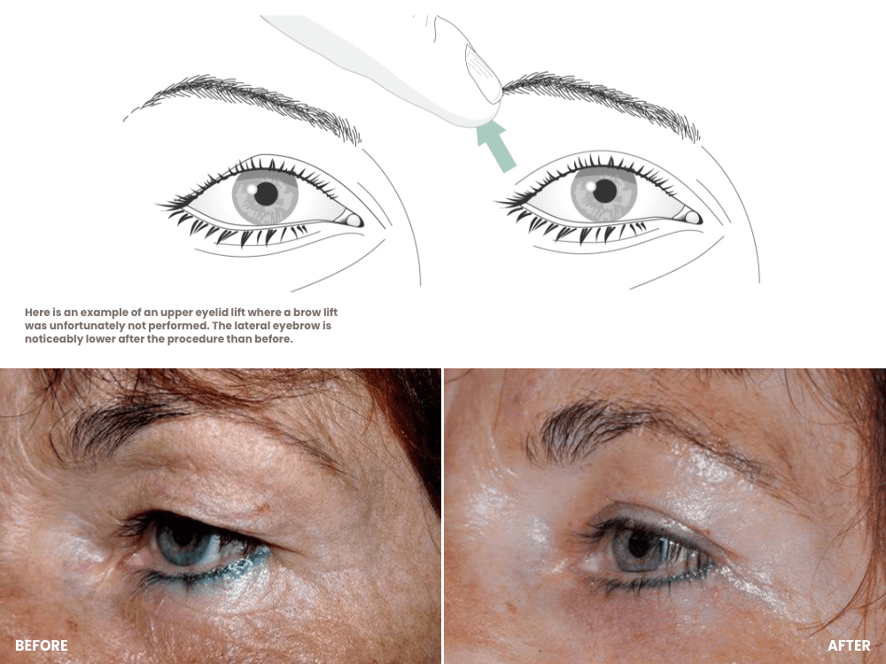 eyelid lift before and after - droopy eyelids