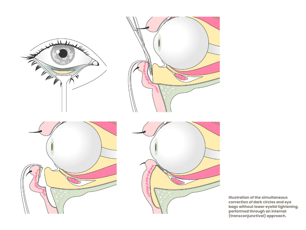 eyelid surgery eye bags young patients