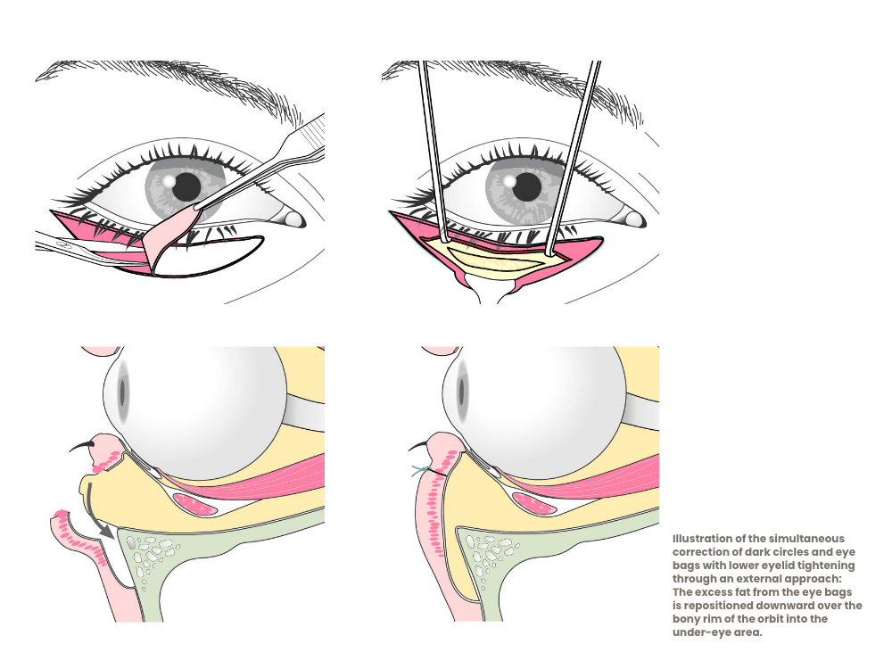 eyelid surgery eye bags and dark circles correction