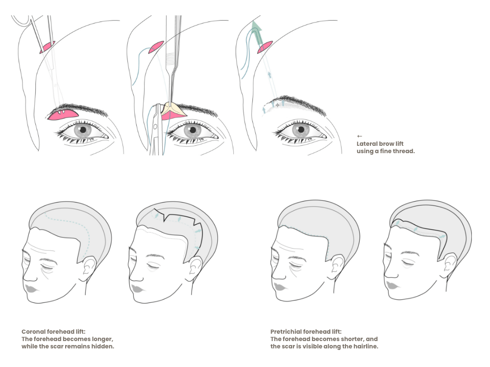 forehead lift and brow lift illustration