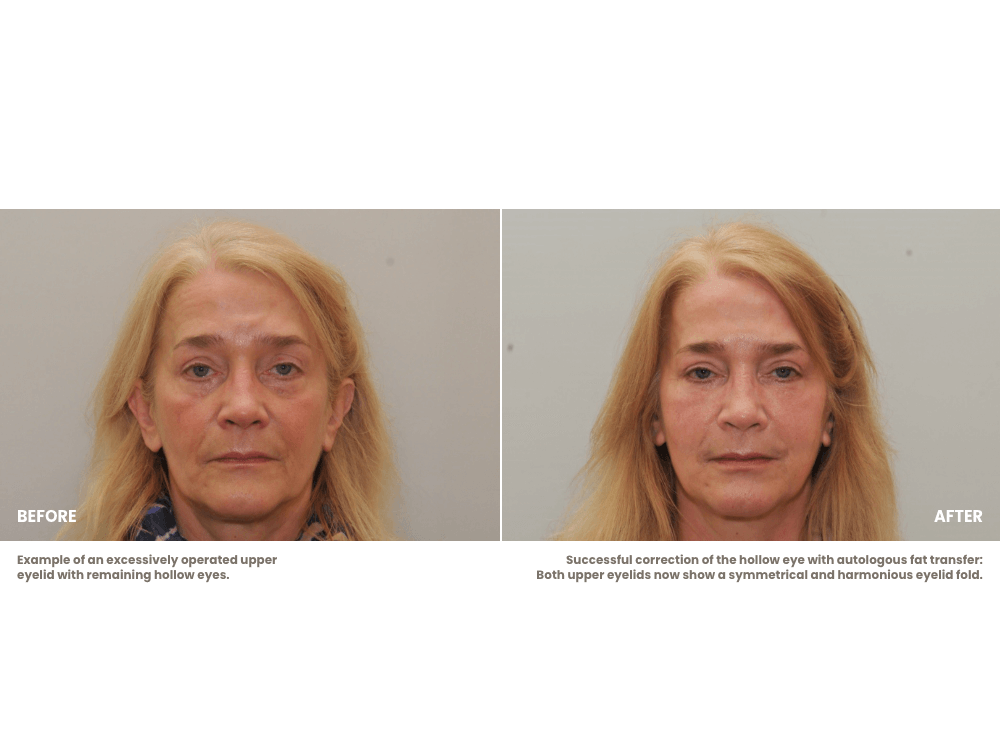 eyelid surgery hollow eyes