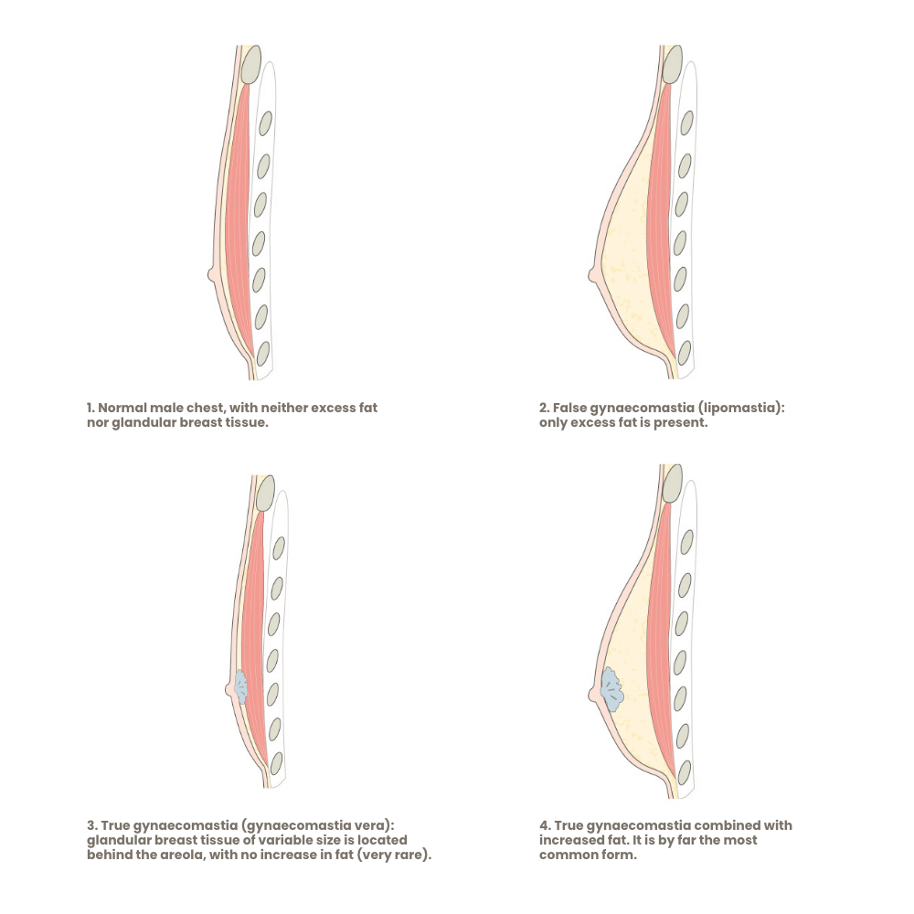 formen-der-gynaekomastie
