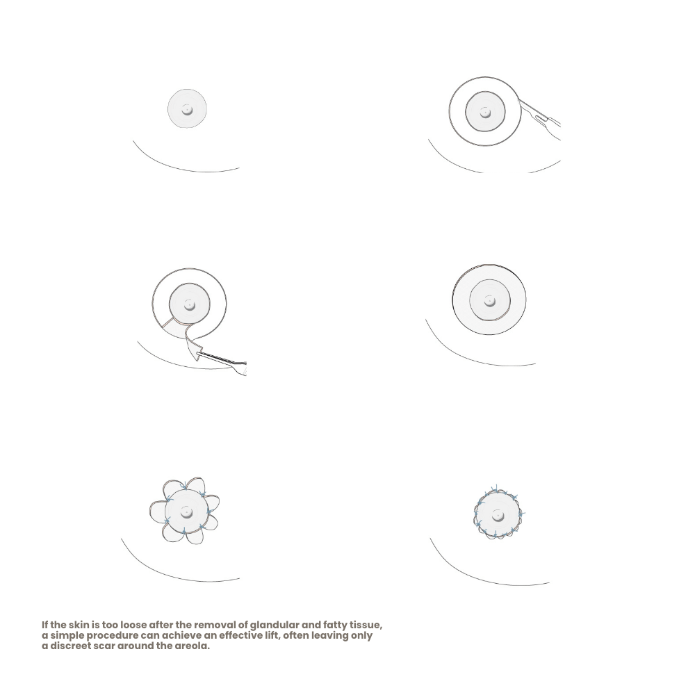 gynaekomastie-warzenhof