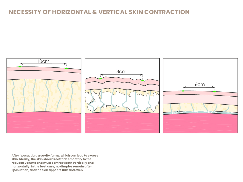hor-vert-schrumpfungsnotwendigkeit