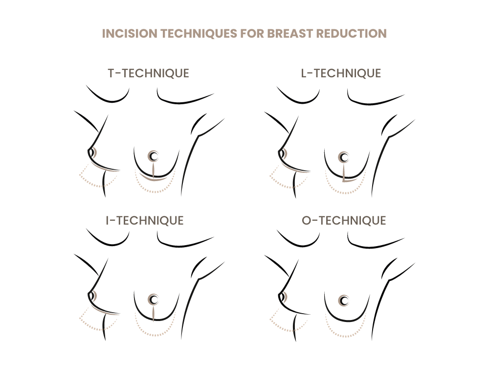 schnittmethoden-brustverkleinerung