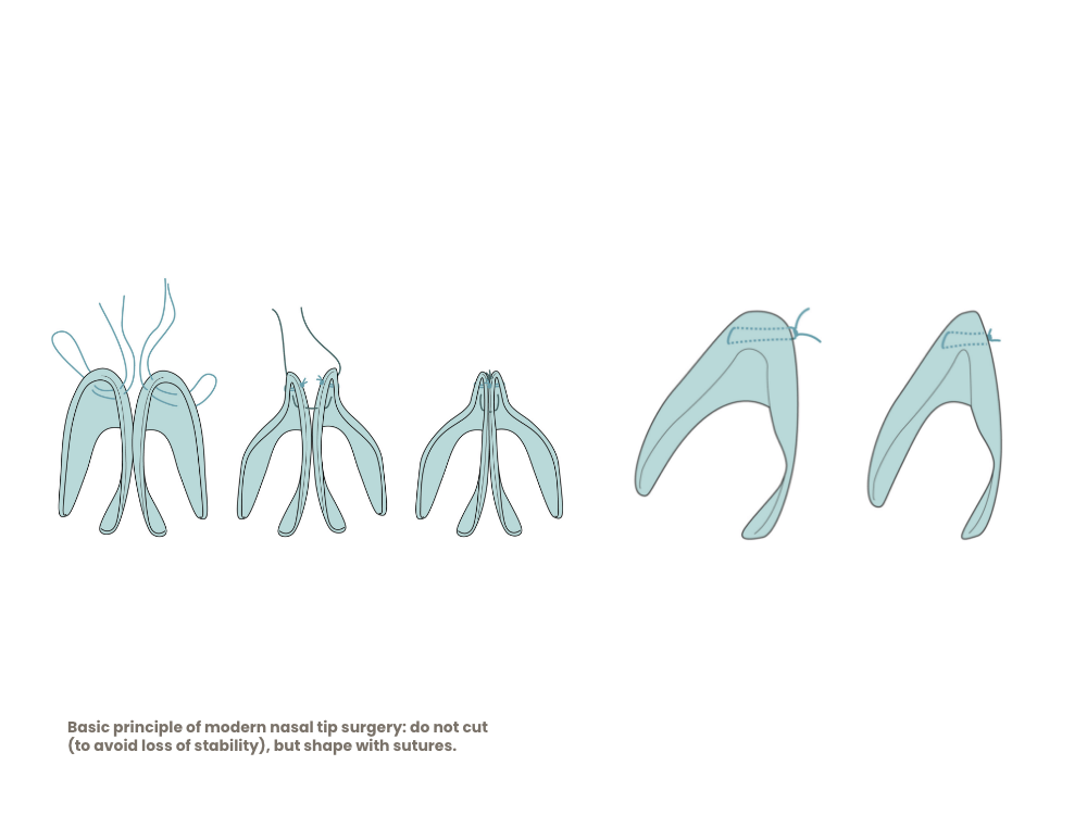 nasenkorrektur-nasenspitzenchirurgie