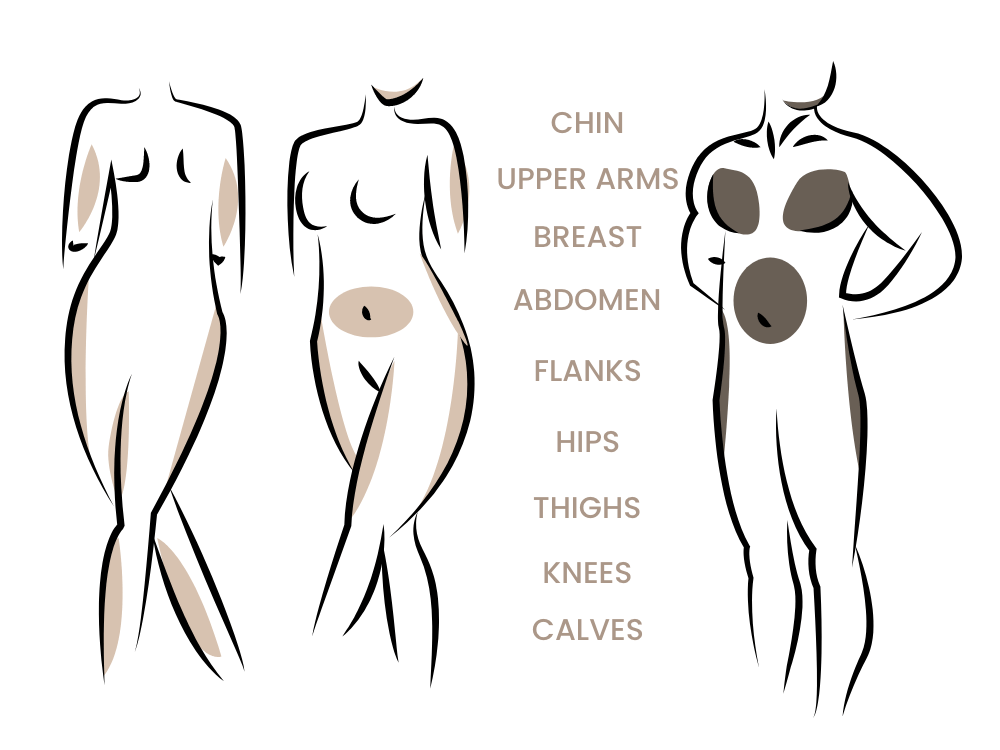 regionen-der-fettabsaugung