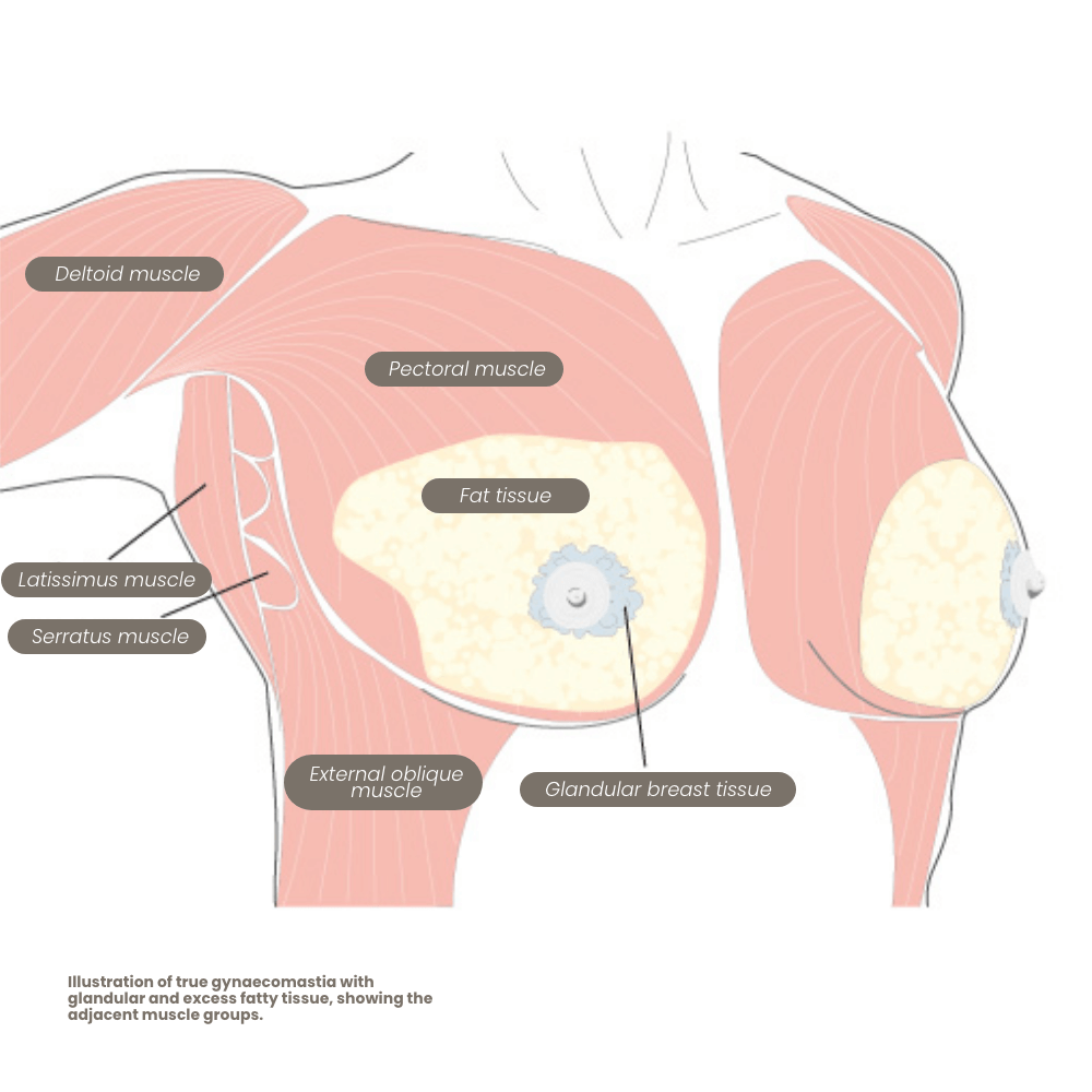 echte-gynaekomastie-mit-brustdruesengewebe-1