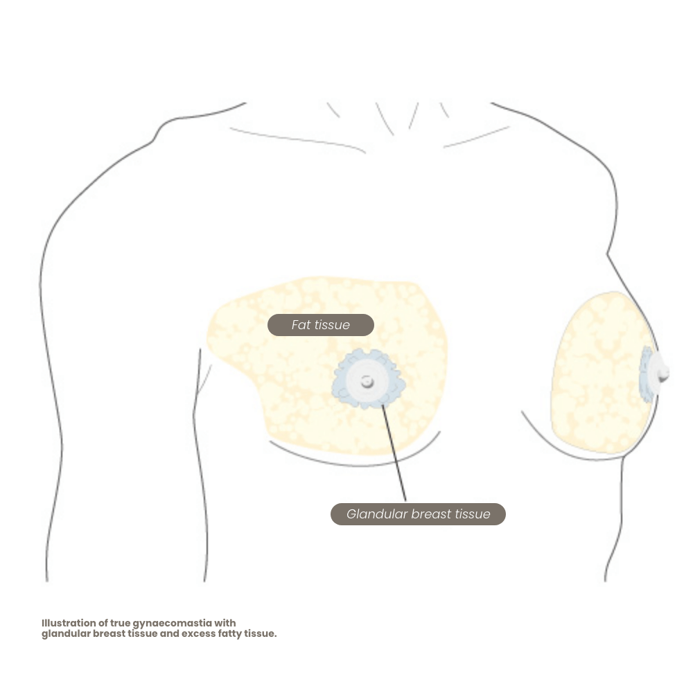 echte-gynaekomastie-mit-brustdruesengewebe-2
