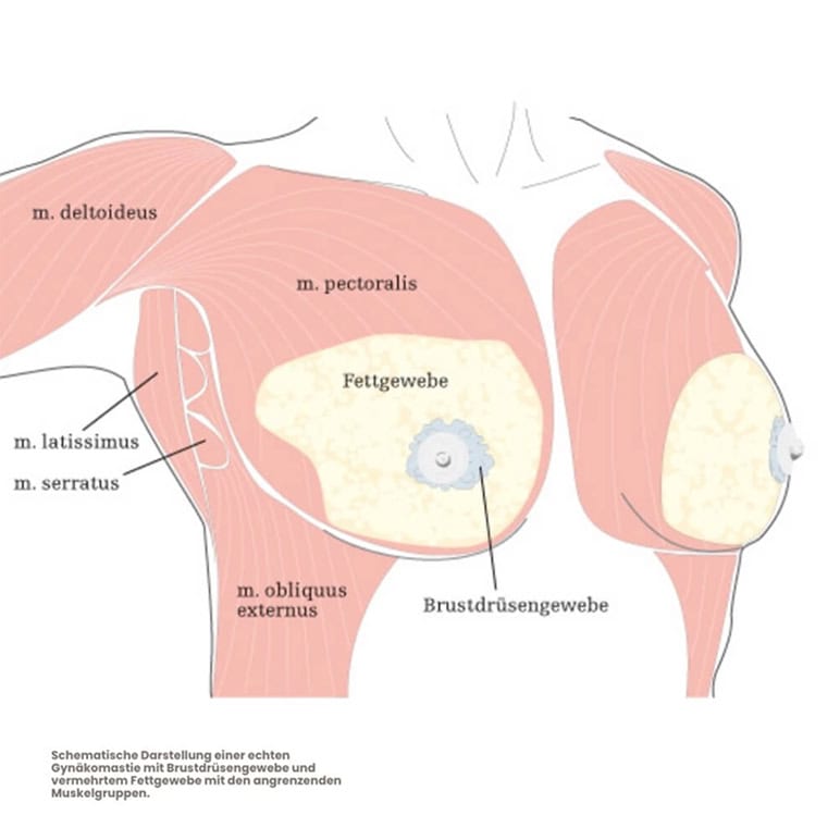 Brustmuskeln bei Gynäkomastie – Anatomische Darstellung