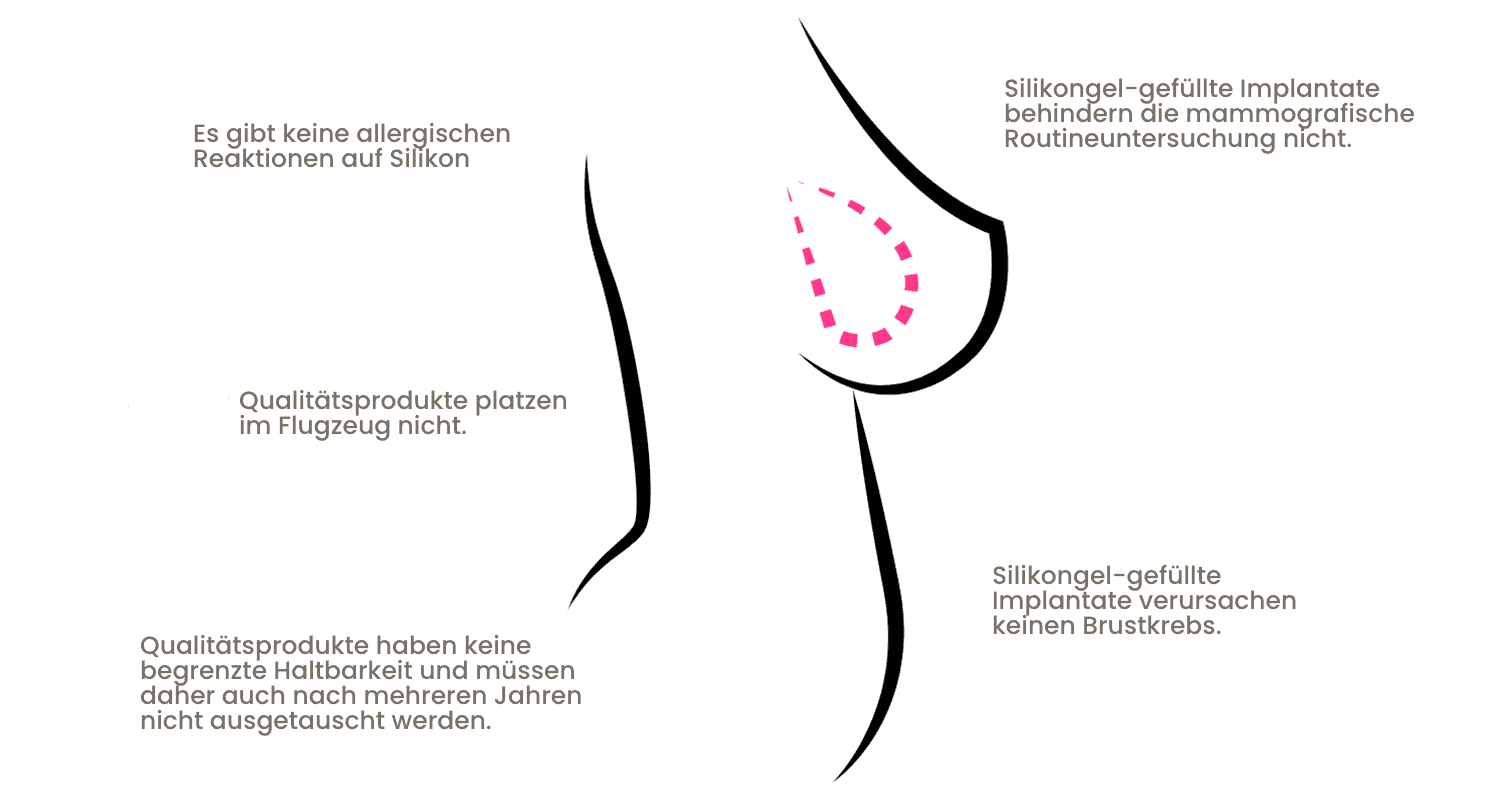 Illustration von Silikongel-Implantaten und deren Auswirkungen auf die Brust.