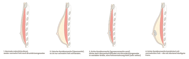 Facelifting für ein jüngeres, strafferes Gesicht.
